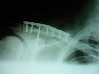 Zlomeniny klíční kosti (fracturae claviculae) | ortopedie-traumatologie.cz