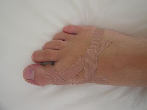 Taping při poškozeních a deformitách nohy a prstů nohy |  ortopedie-traumatologie.cz