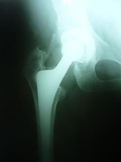 Totální endoprotéza kyčelního kloubu (TEP kyčle, alloplastika kyčelního  kloubu, náhrada kyčelního kloubu) | ortopedie-traumatologie.cz
