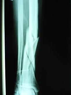Zlomeniny proximálního bérce (fractura cruris proximalis, fractura plato  tibie) | ortopedie-traumatologie.cz