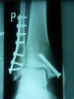 Zlomeniny hlezenního kloubu (fractura tibie distalis, fractura  bimalleolaris, fractura trimalleolaris) | ortopedie-traumatologie.cz